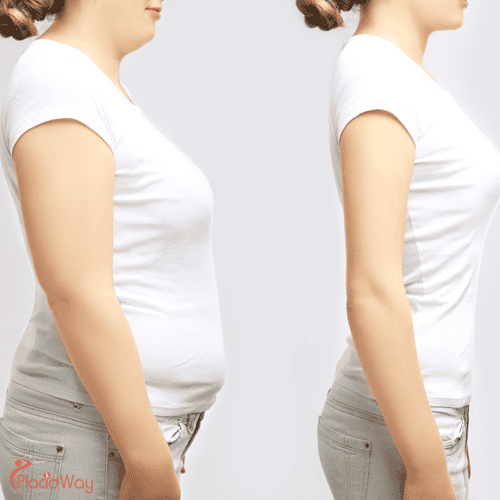 Case Study: How A Patient Lost 180 lbs with Gastric Sleeve Surgery in Mexicali, Mexico